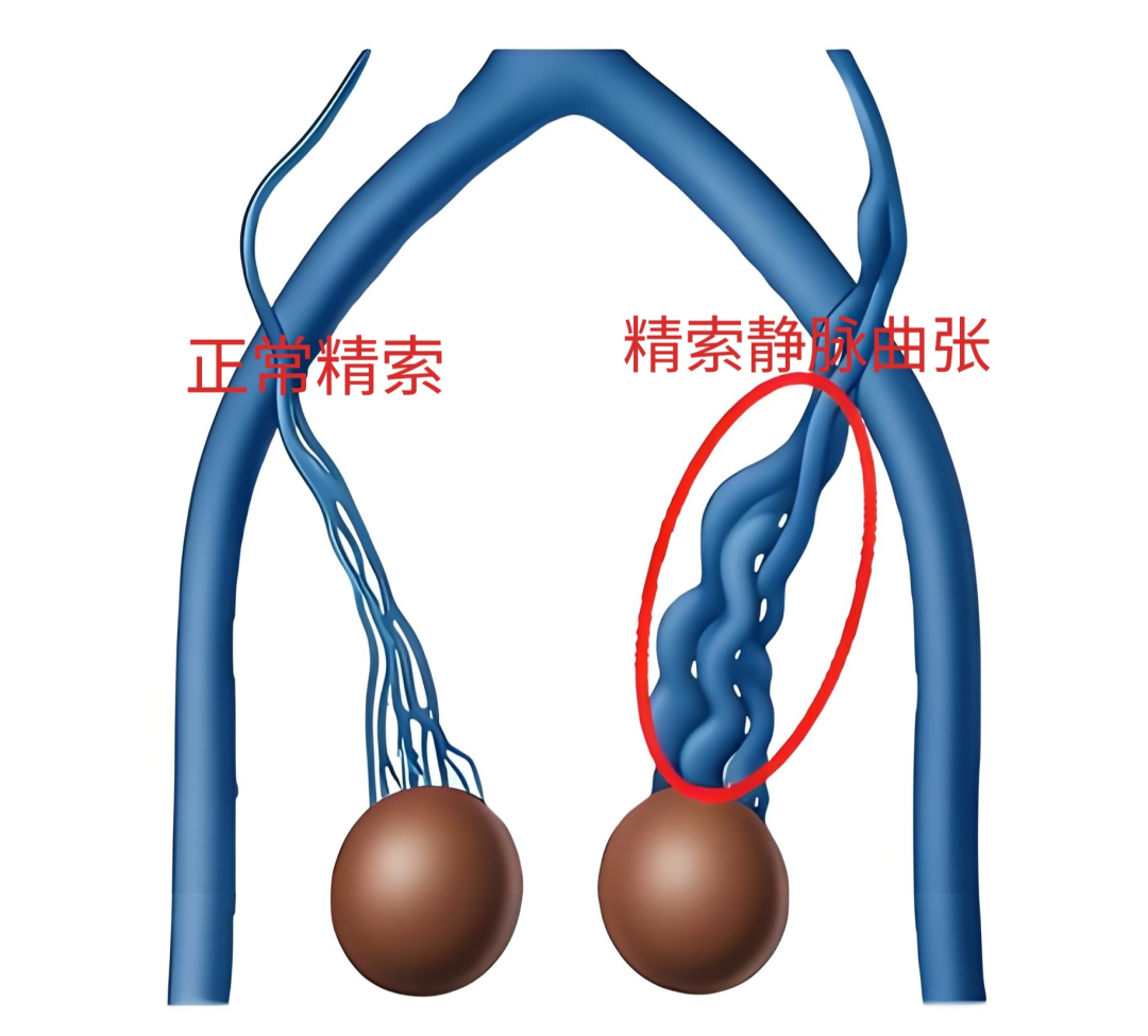 坠胀不适、运动隐痛？细说年轻人高发的精索静脉曲张
