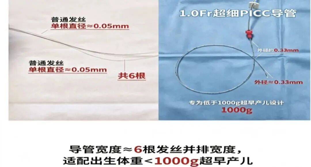 粤北首例!韶妇幼为超早产儿置入全球最细1.0Fr PICC导管→