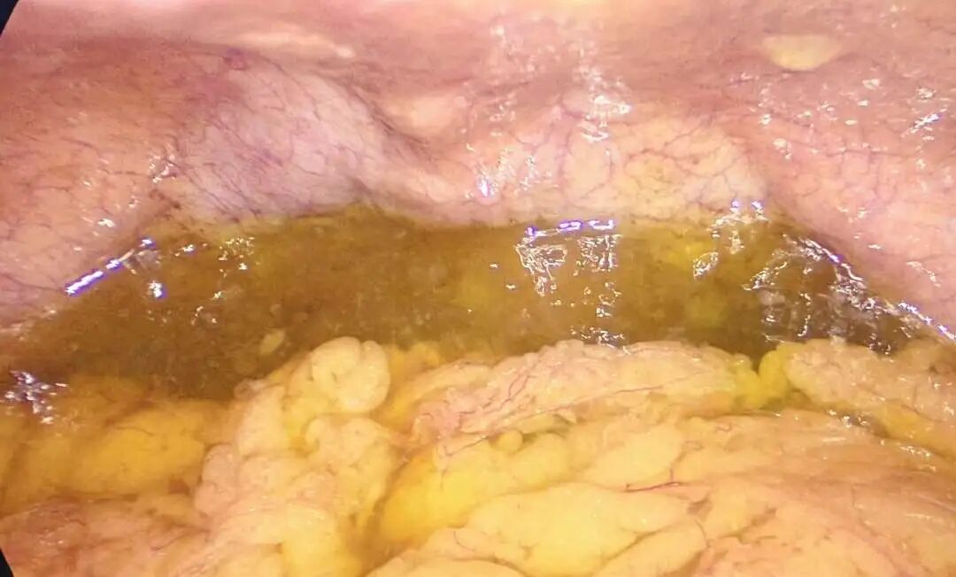 女子腹痛忍了十几年!谁知腹腔长满果冻样肿瘤