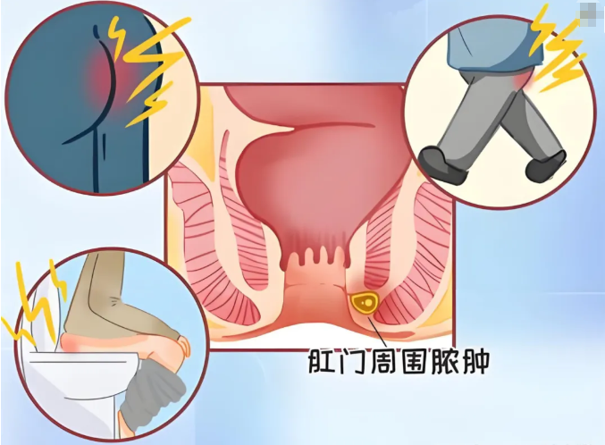 台风天“菊部”告急?别把脓肿当痔疮!