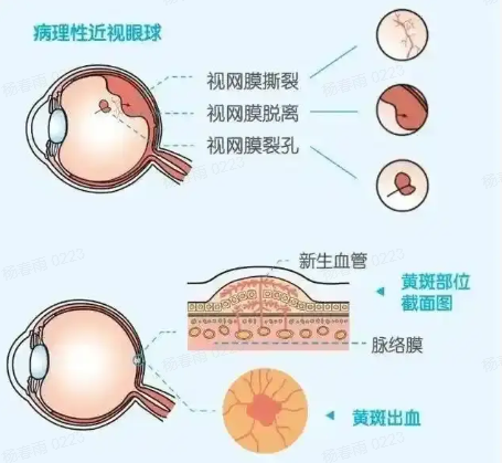什么是病理性近视?单纯高度近视和病理性近视,别再混为一谈!