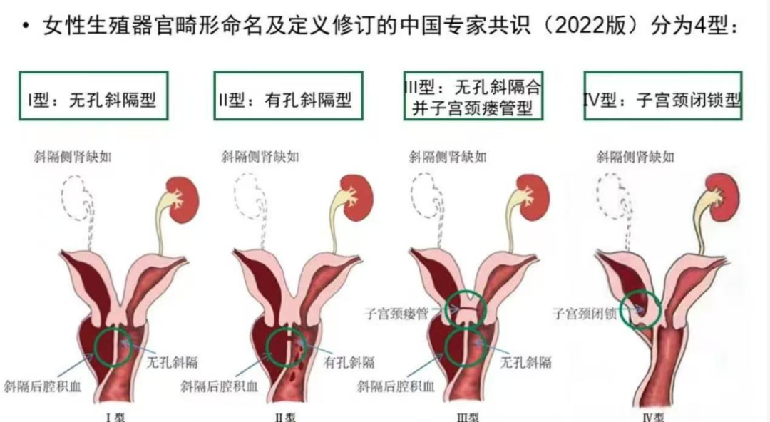 初潮后痛经越来越严重,警惕这种极易误诊的罕见妇科畸形