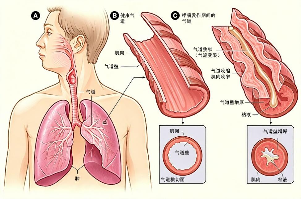【儿童哮喘科普・第一期】孩子总半夜咳醒别当感冒!儿科主任:儿童哮喘的真相,很多家长都搞错了