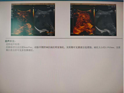 一体化精准施治！国文医院救治 38 岁遗传性息肉病合并肠癌患者