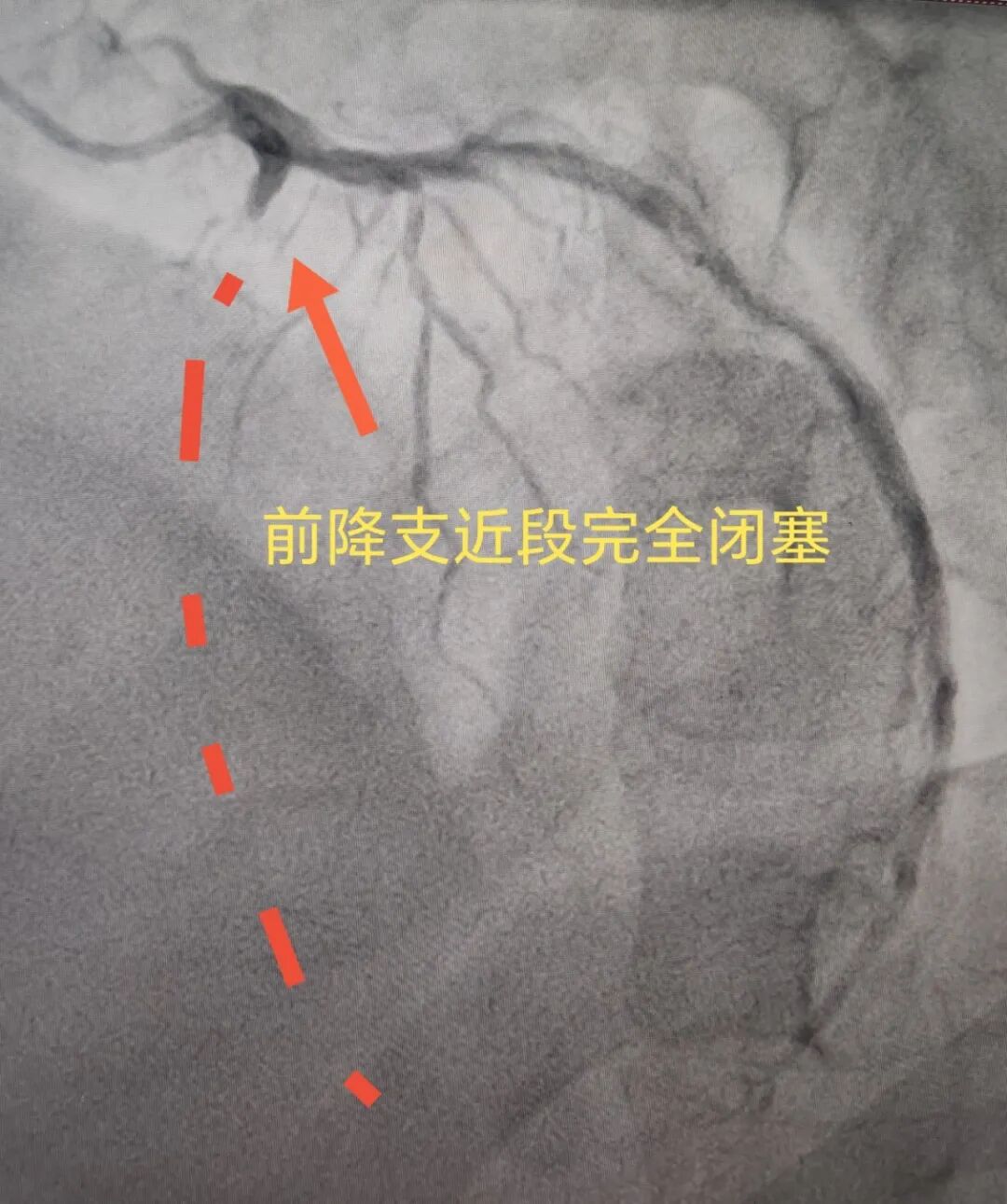 腹痛就医,突发心跳骤停!胸痛中心成功救回