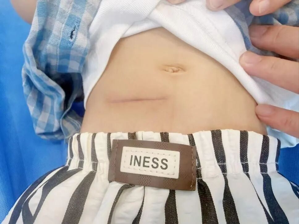 交医精术丨惊险！2岁幼童误吞枣核肠穿孔，交大一附院陆港院区成功施救
