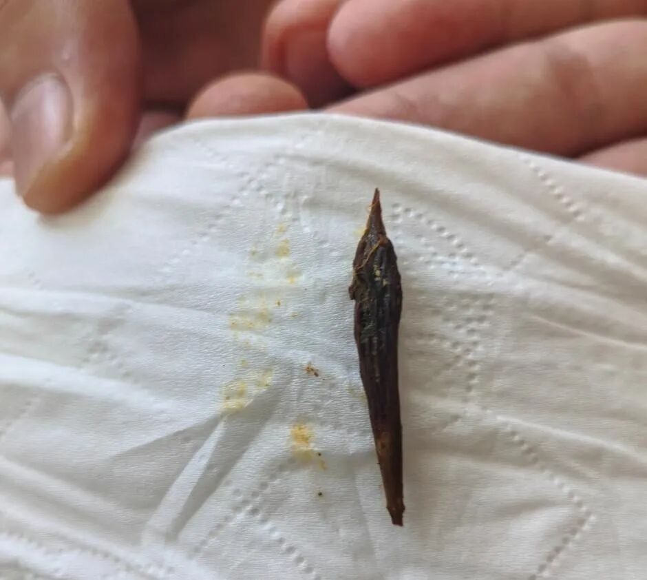 交医精术丨惊险！2岁幼童误吞枣核肠穿孔，交大一附院陆港院区成功施救