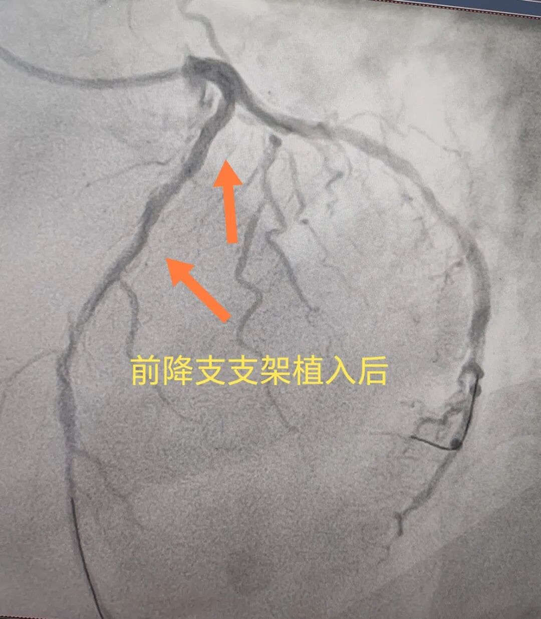 腹痛就医,突发心跳骤停!胸痛中心成功救回