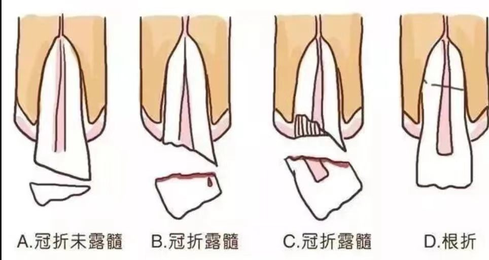 牙齿磕断了，千万别扔！还可以抢救一下