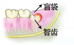 别把智齿肿痛当上火！严重可致间隙感染、呼吸困难！