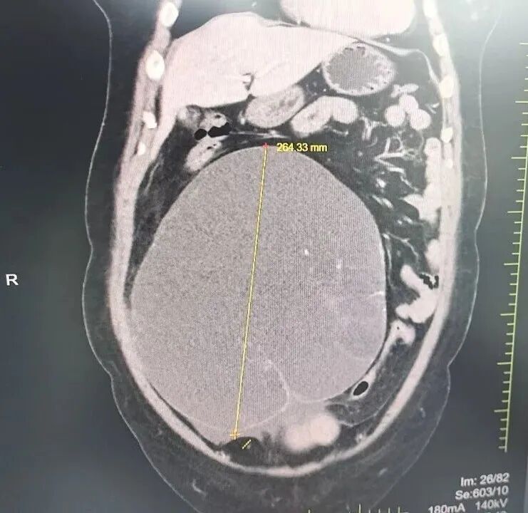 腹胀竟不是消化疾病?国文医院妇科为其切除直径26厘米巨大盆腔肿物