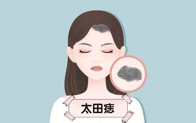 脸上挥之不去的蓝灰斑片,警惕太田痣
