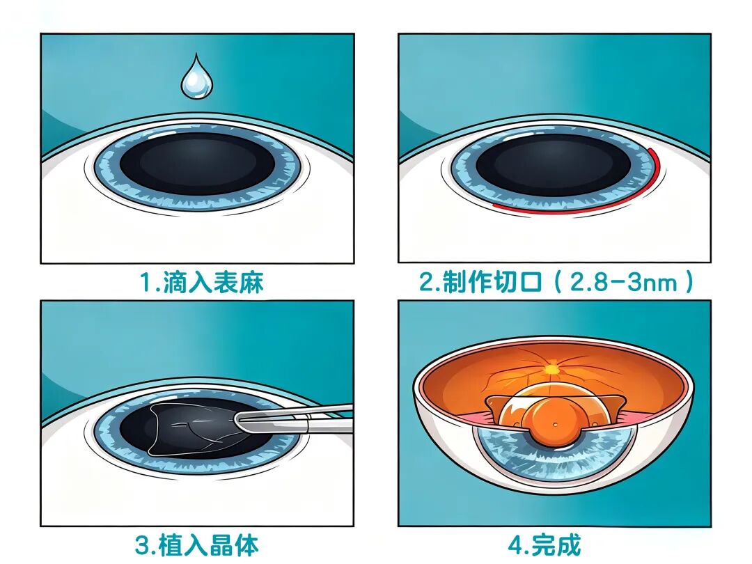 ICL,靠谱吗?