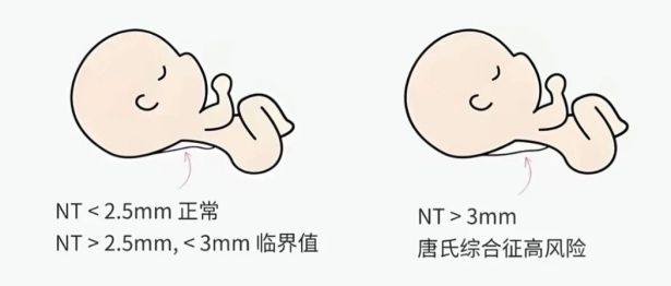 【协作组科普】孕早期排畸第一关：读懂NT检查，心里有底不慌张