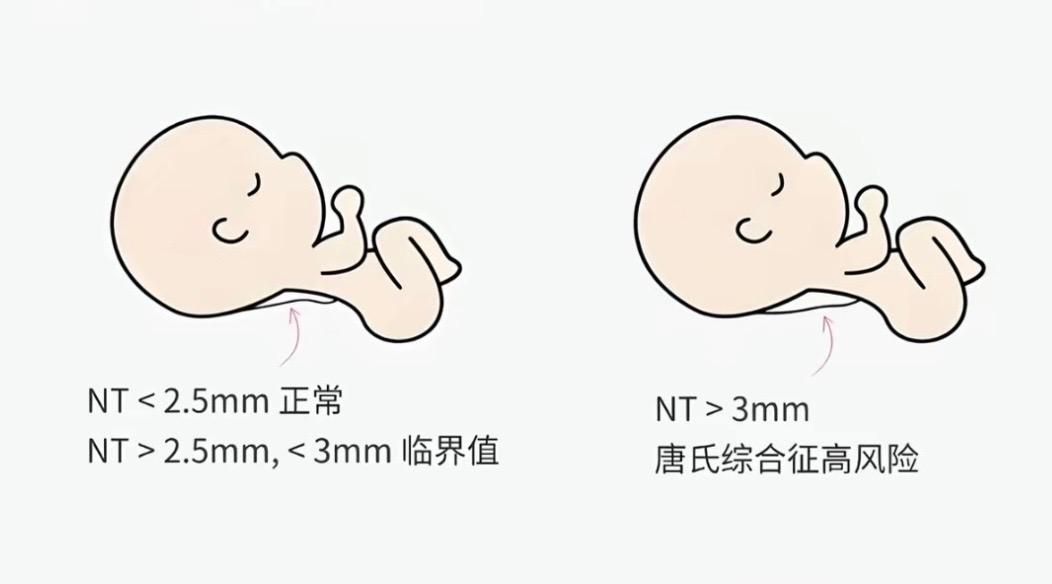 【协作组科普】孕早期排畸第一关：读懂NT检查，心里有底不慌张