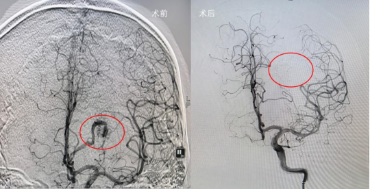 饭后一阵“晕碳”,30岁小伙直接被送进手术室!医生:经常头痛的人,一定得查!