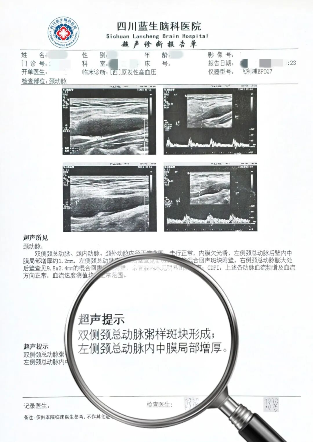 发现颈动脉斑块,别只盯着大小,关键还要看这两个指标......
