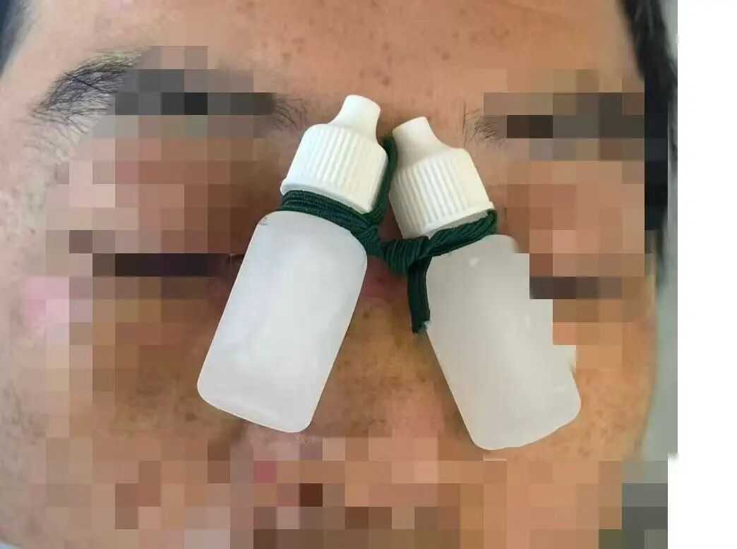 告别“猪鼻子”与抽纱条恐惧,鼻部手术术后体验迎来新改善