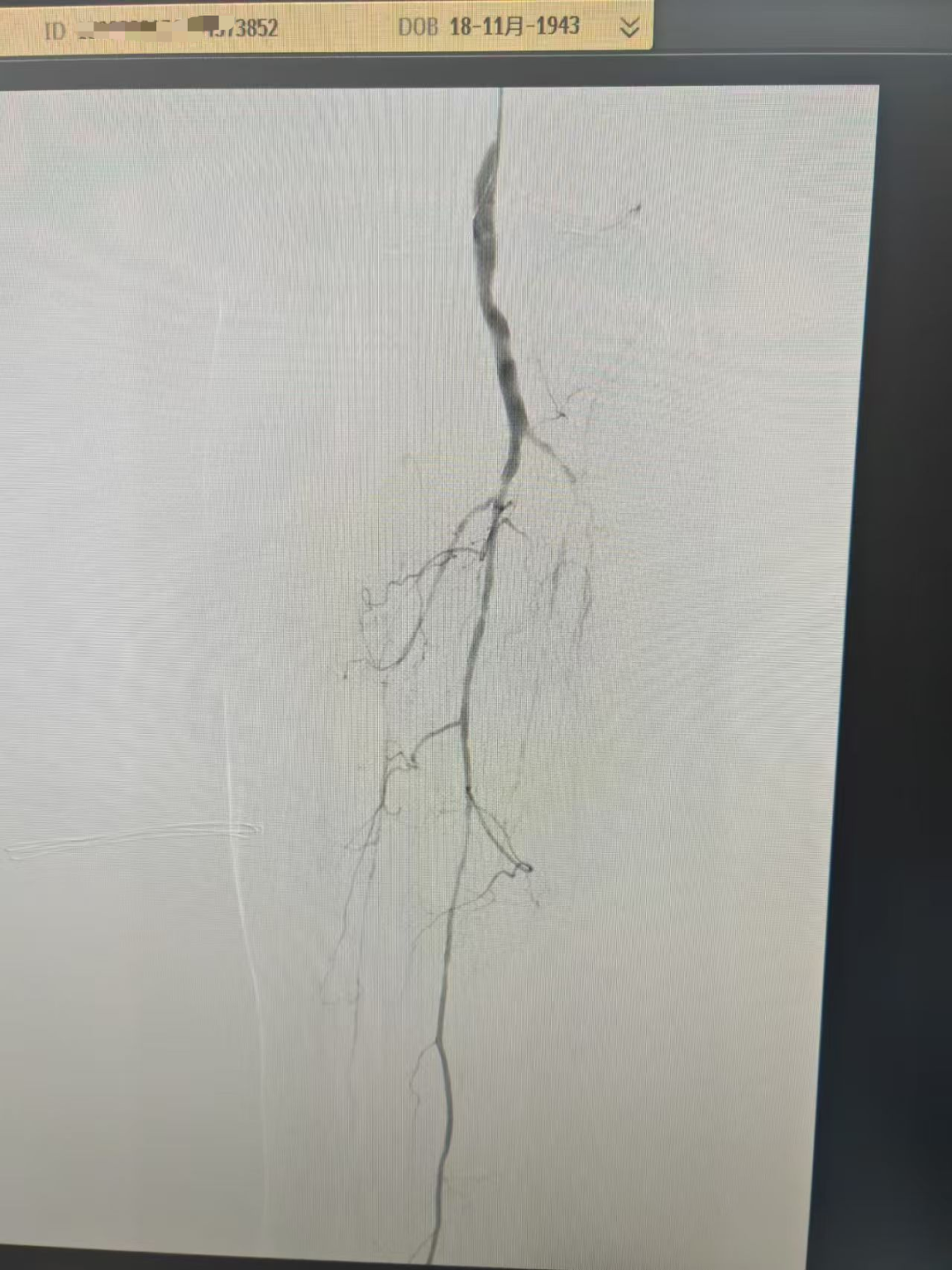 【媒体聚焦】八旬老人双下肢严重缺血行走困难,我院心内科微创球囊扩张术成功打通闭塞血管