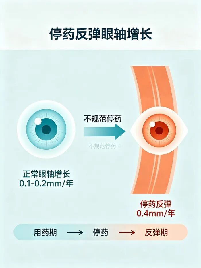 10岁男孩两年近视飙至950度:阿托品自行“说停就停”,反弹代价远超家长想象