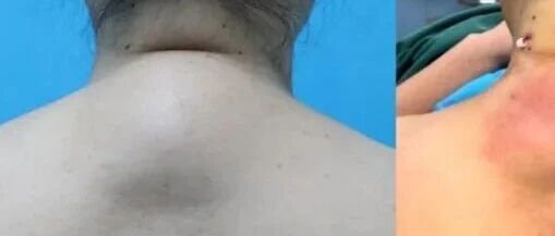 颈后隆起「富贵包」，不仅影响形态，还会引起颈肩酸胀头昏不适，微创手术矫治