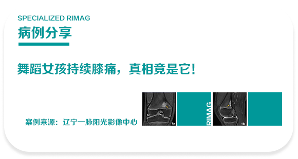 典型病例 | 舞蹈女孩持续膝痛,真相竟是它!
