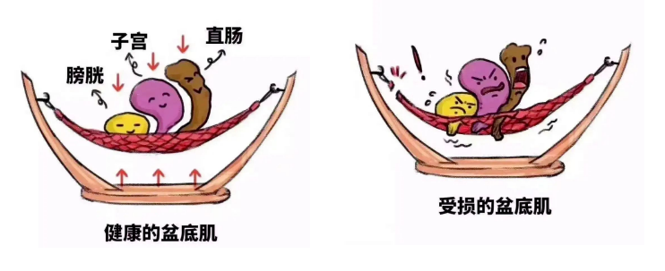 医语辟谣|生完孩子“没漏尿”就没有盆底损伤?NO!