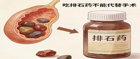 胆囊结石怎么办？只能吃药排石or切掉胆囊？