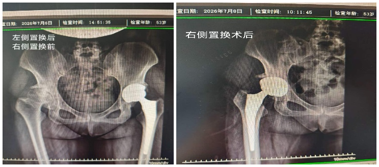 髋关节发育不良：忍了十年痛，最后换了两个「新关节」
