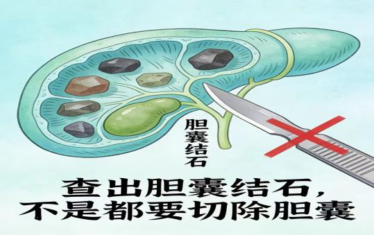 胆囊结石怎么办?只能吃药排石or切掉胆囊?