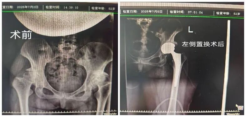 髋关节发育不良：忍了十年痛，最后换了两个「新关节」