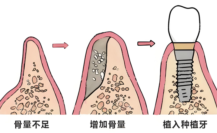 缺牙多年,牙根骨都没了,还能种牙吗?
