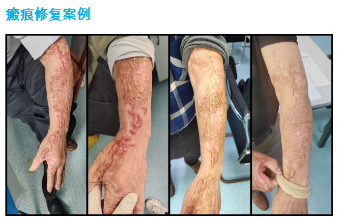 润心科普丨疤痕、白癜风反复治不好?环钻术给你新希望