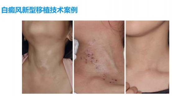 润心科普丨疤痕、白癜风反复治不好?环钻术给你新希望