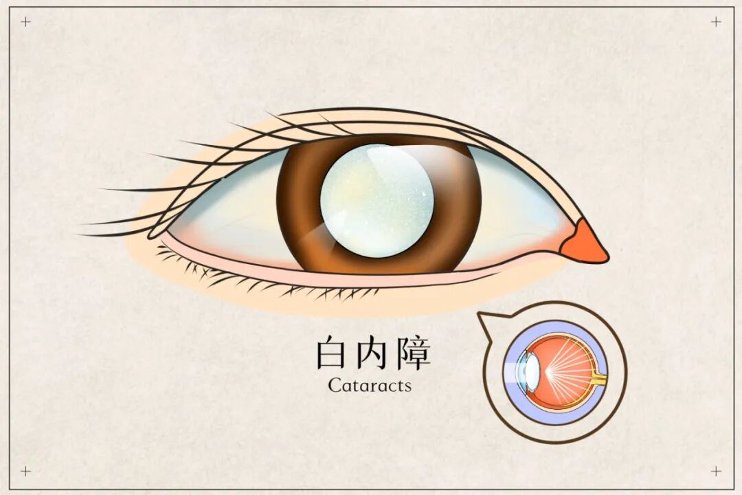 这届年轻人,正悄悄被白内障“盯上”...