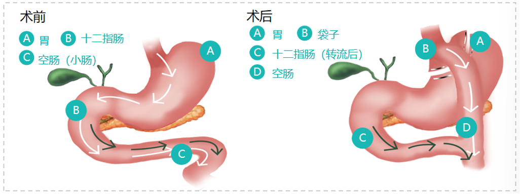 不切胃不挨刀，减重新技术来了→