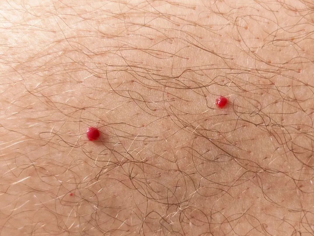 身上冒出不痛不痒小红点，到底是什么？要治吗？