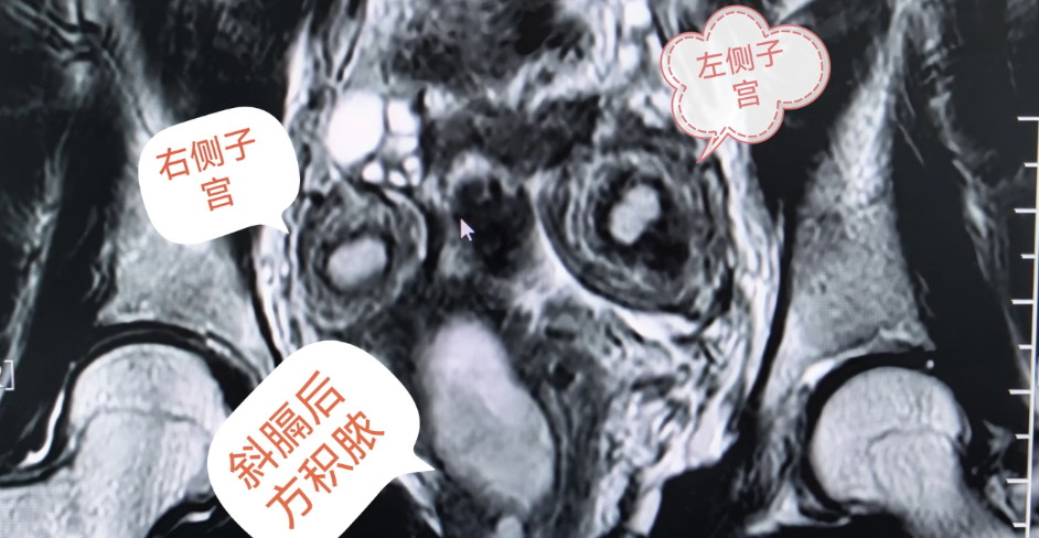 痛经十年,21 岁姑娘查出罕见病:体内竟多了道「隔断墙」