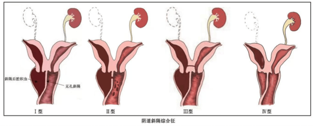 痛经十年，21 岁姑娘查出罕见病：体内竟多了道「隔断墙」