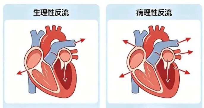 心脏瓣膜轻度反流？是心脏“阀门”破损了吗？