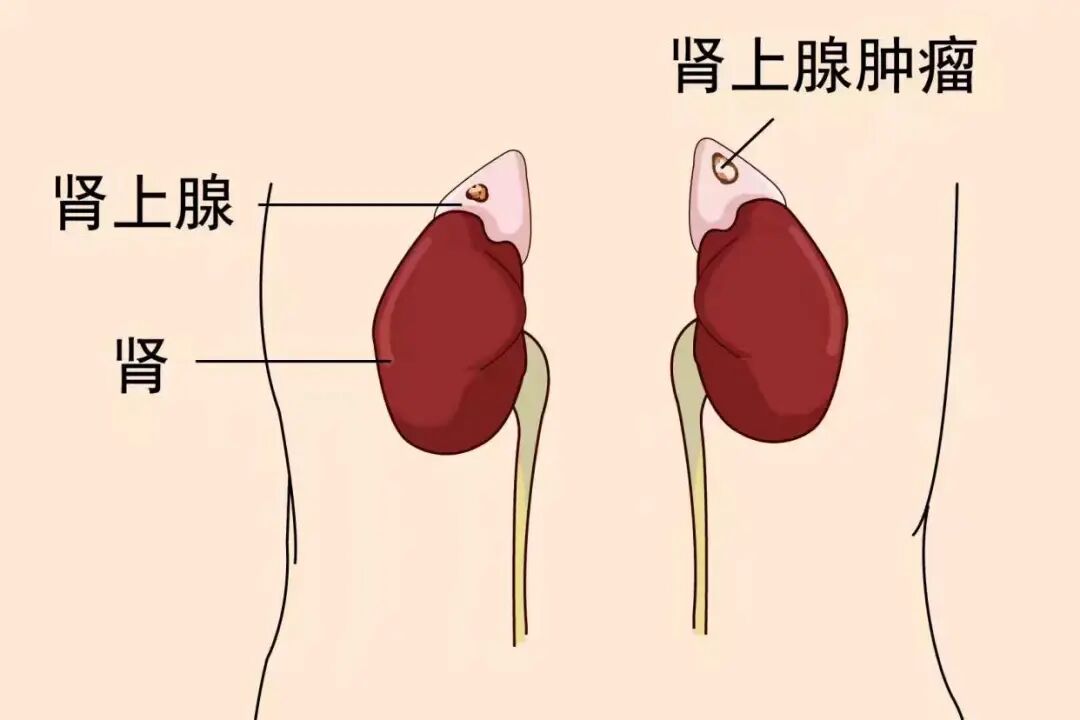 血压高居不下,病因或许在肾上腺