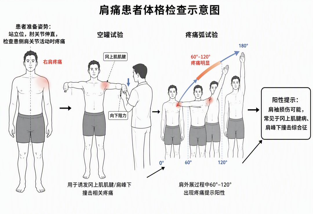 肩痛就是肩周炎?当心肩袖损伤这个“李鬼”!