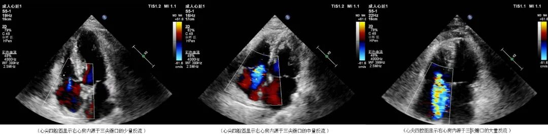 心脏瓣膜轻度反流？是心脏“阀门”破损了吗？