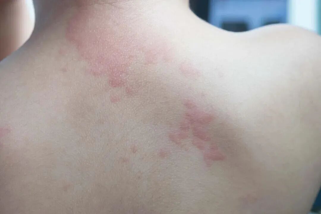 皮肤突然“闹脾气”?一份过敏性皮炎应对指南请查收