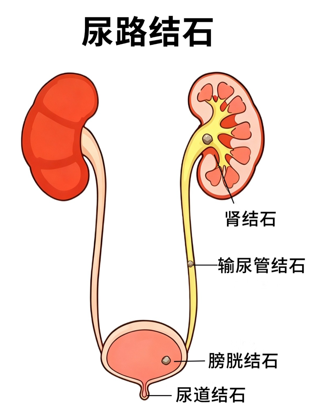 尿路结石从何而来？这6个坏习惯会加速结石形成！