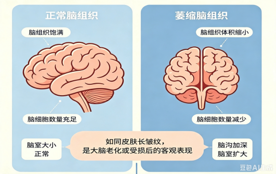 【人医科普】查出脑萎缩别恐慌!与痴呆并非一回事
