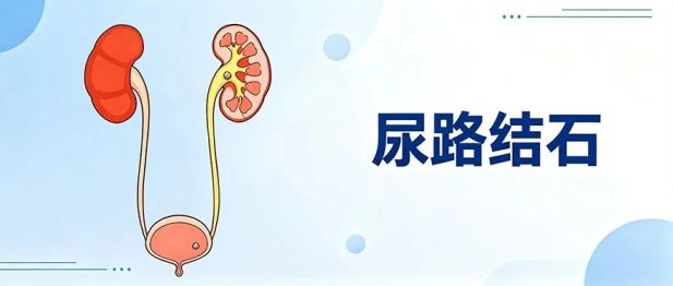尿路结石从何而来？这6个坏习惯会加速结石形成！