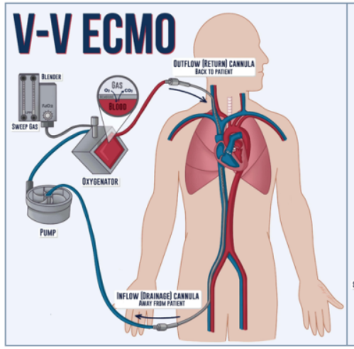 生死竞速！ECMO 硬核护航 我院成功抢救重度沼气中毒患者