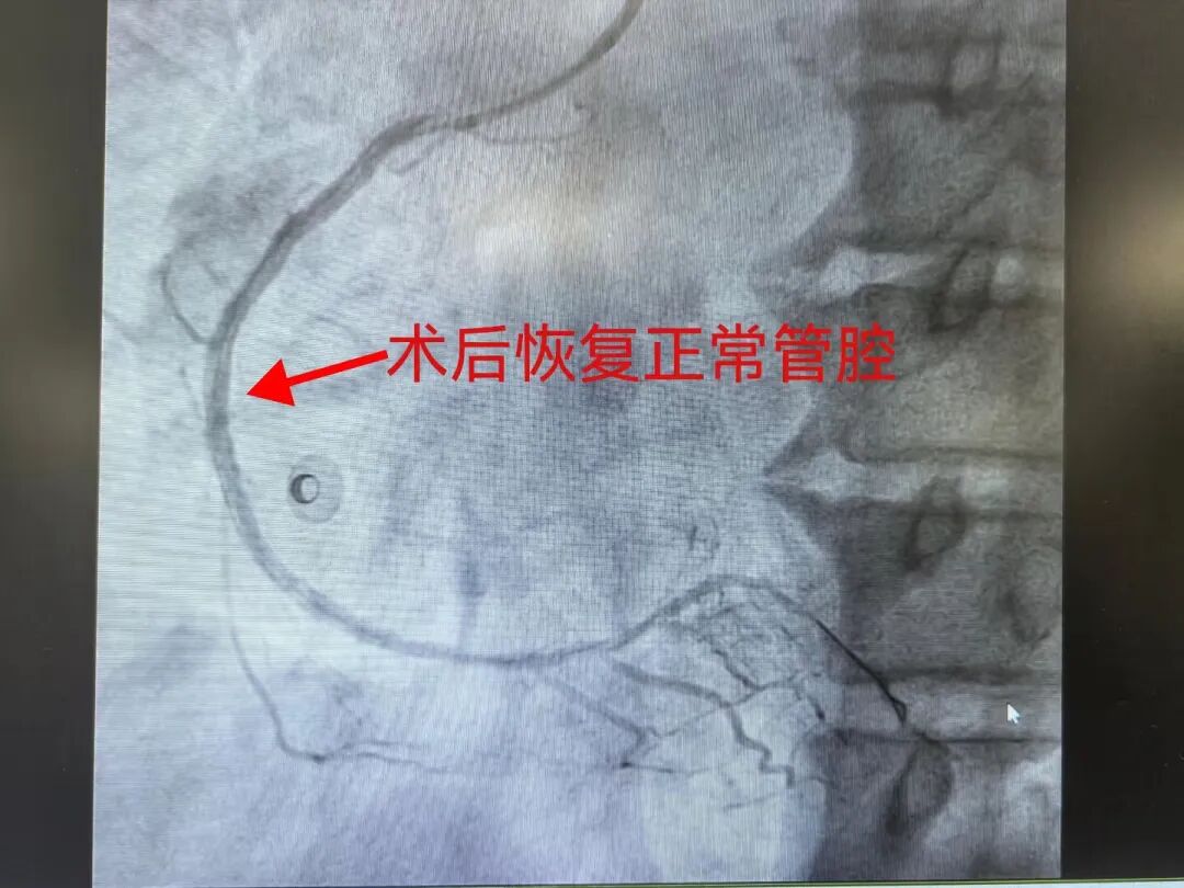 57岁男子三条冠脉同时严重堵塞,一次介入手术全部开通