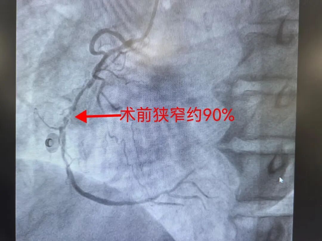 57岁男子三条冠脉同时严重堵塞,一次介入手术全部开通